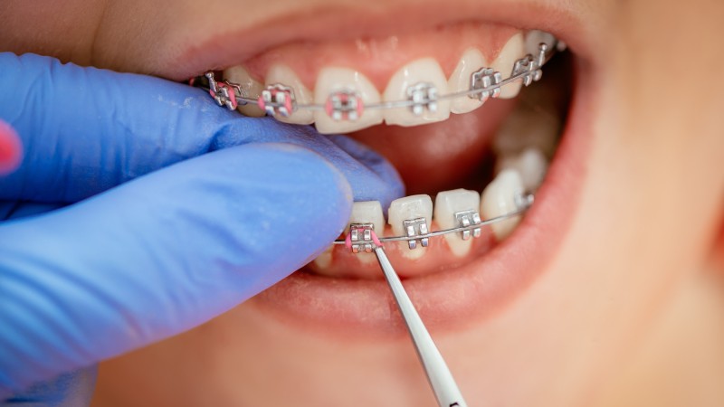 تکنولوژی در ارتودنسی دندان