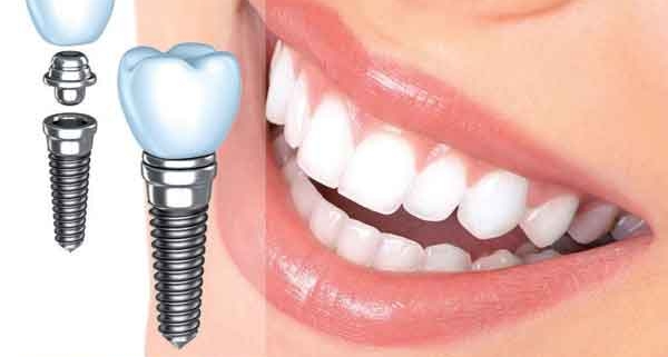 ممنوعیت های بعد از ایمپلنت دندان
