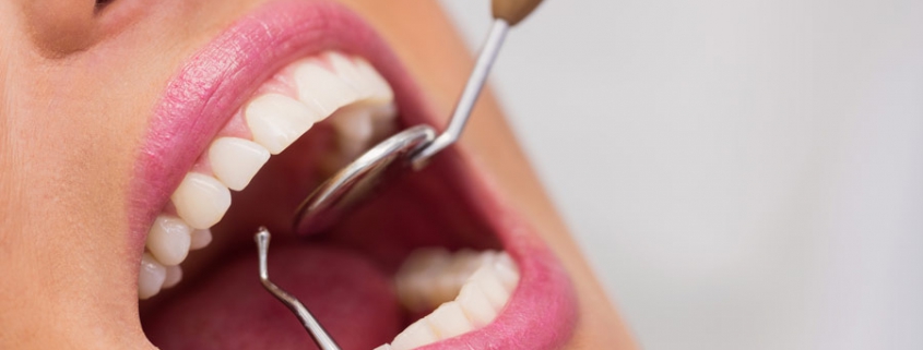 مراحل-انجام-لمینت-دندان