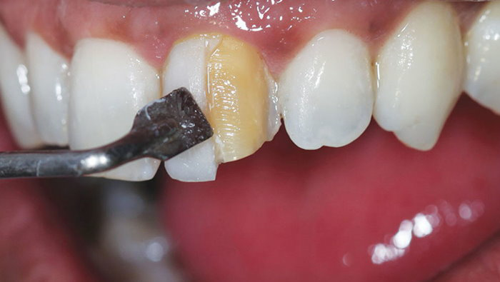 کامپوزیت-دندان