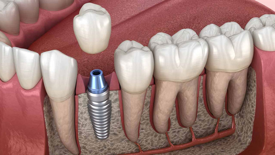 شرایط-ایمپلنت-دندان