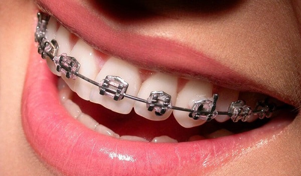 روش-ارتودنسی-دندان