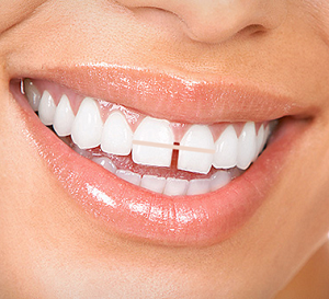 انواع جراحی ایمپلنت دندان