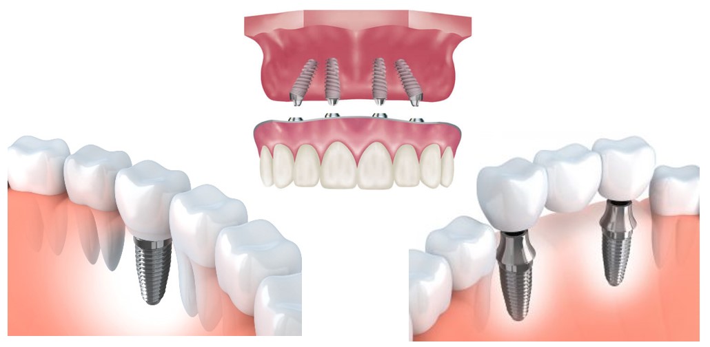 ابزار های ایمپلنت دندان