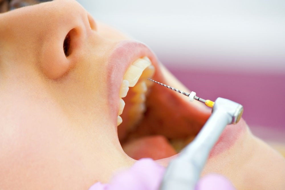  مراقبت های بعد از درمان ریشه دندان