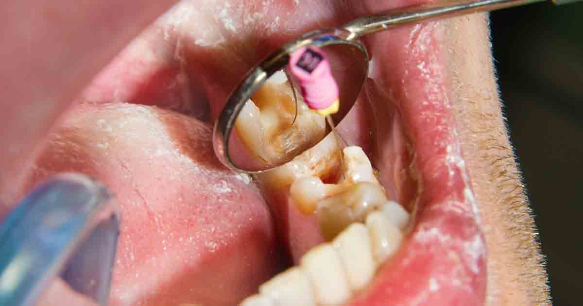 درمان-ریشه-دندان