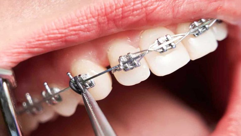 ارتودنسی دندان قلهک