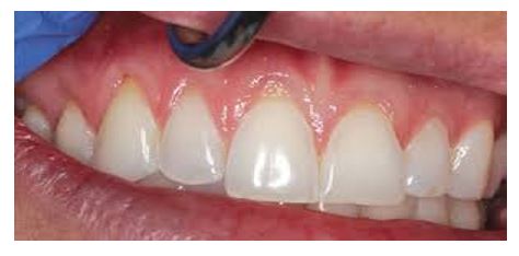 روش جایگزین کامپوزیت دندان