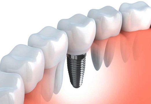 دستور العمل ایمپلنت دندان