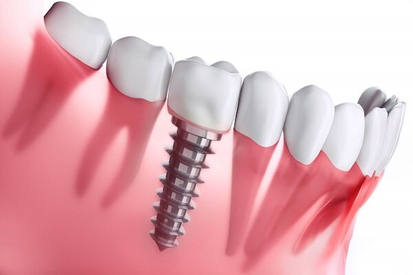 نکات-کاهش-درد-ایمپلنت-دندان