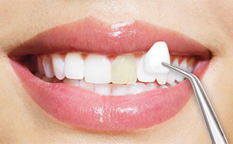 مراقبت های کامپوزیت دندان