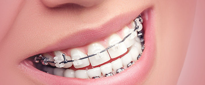 ارتودنسی دندان 