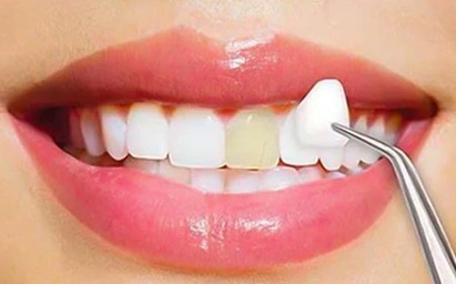 نکات مهم در لمینت دندان