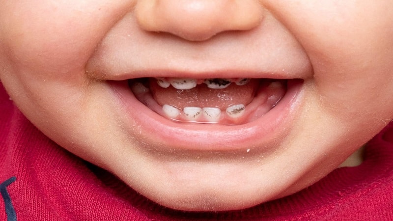 پوسیدگی دندان اطفال
