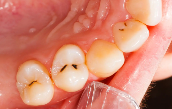 انواع پوسیدگی دندان