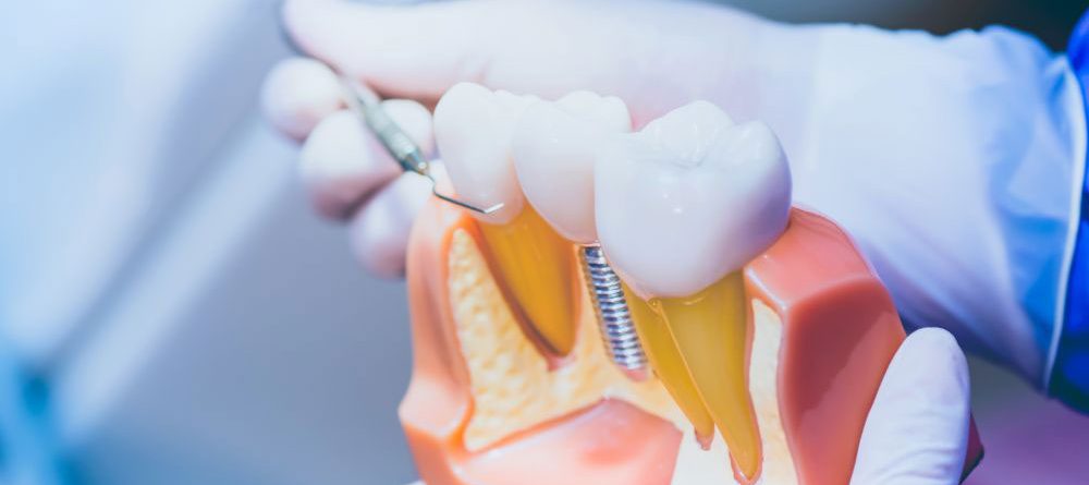کاهش-درد-ایمپلنت-دندان