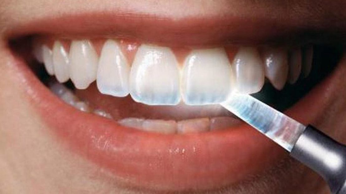 سایش دندان