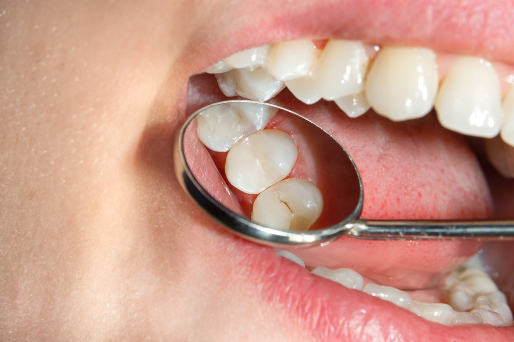عوامل تاثیرگذار بر تغییر رنگ کامپوزیت دندان