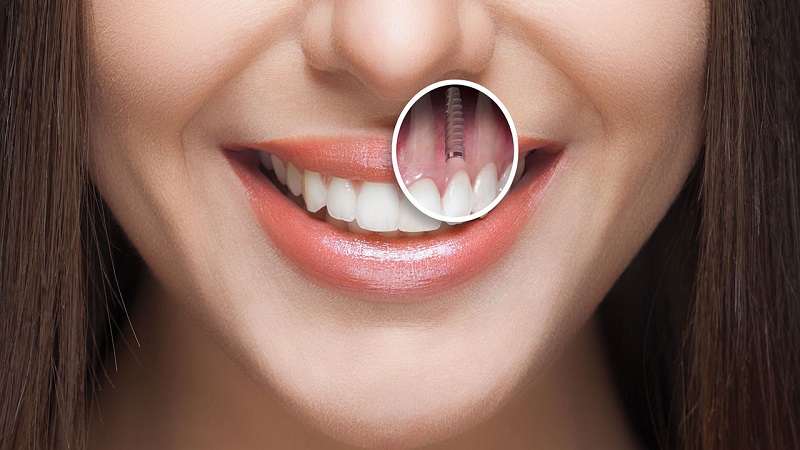 ایمپلنت دندان؛ تولدی دوباره برای لبخند شما