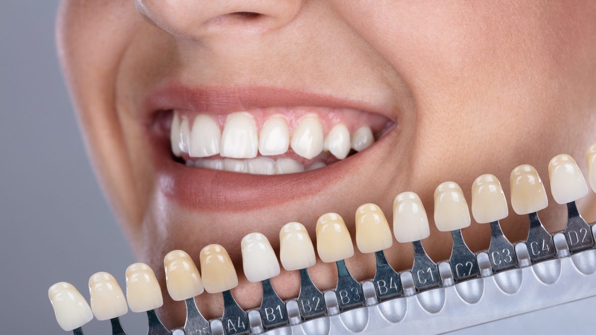 چگونه کامپوزیت دندان را می چسبانند؟