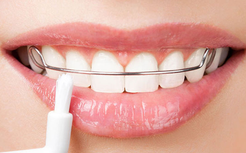 ارتودنسی دندان تا چه سنی امکان پذیر است؟