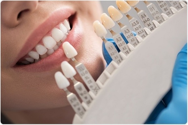 ماندگاری اثرگذار لمینت دندان
