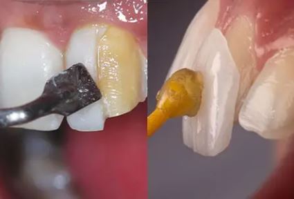 لمینت یا کامپوزیت؟ مقایسه کامل برای انتخاب بهتر