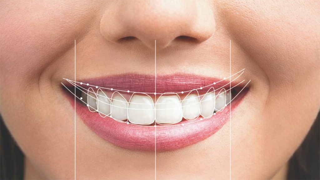 انجام لمینت دندان چه مراحلی دارد؟