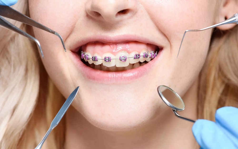 ارتودنسی دندان مرحله به مرحله
