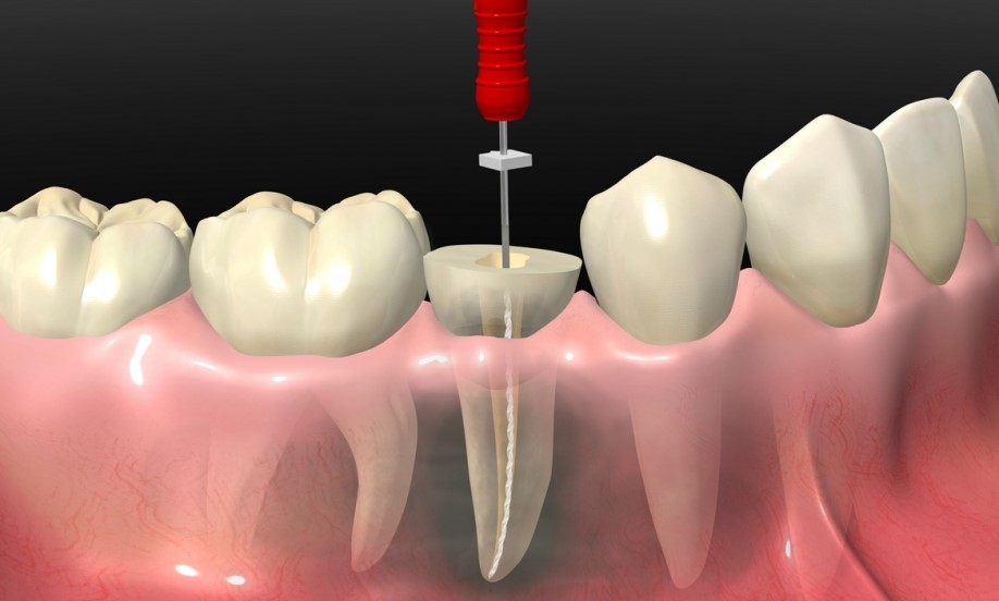 درمان ریشه دندان در جوانی
