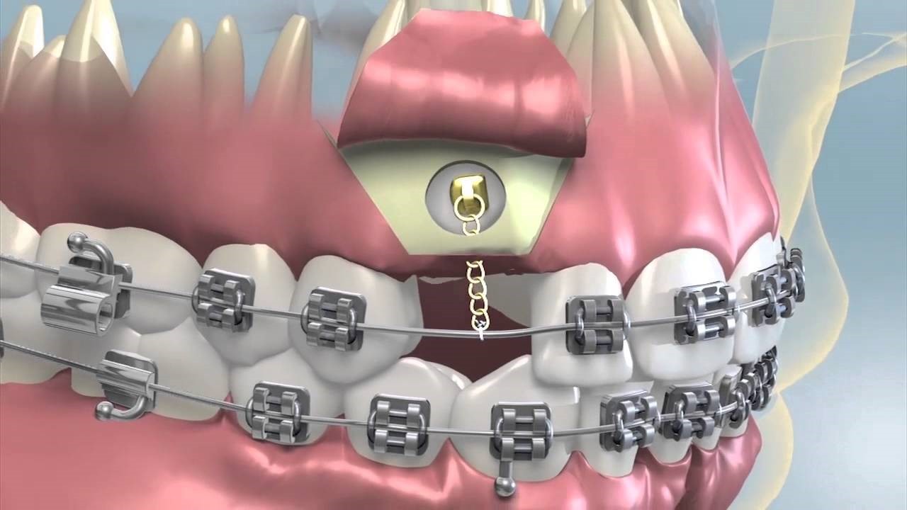 آیا می شود فقط یک دندان را ارتودنسی کرد؟