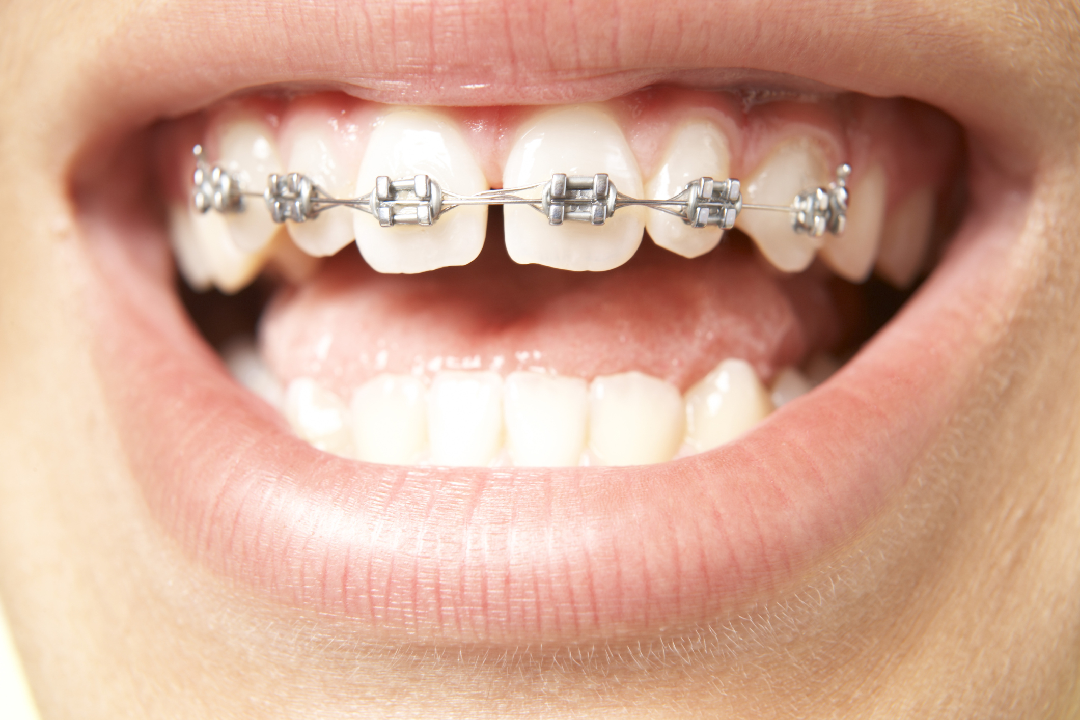 هزینه ارتودنسی دندان برای  یک دندان کج