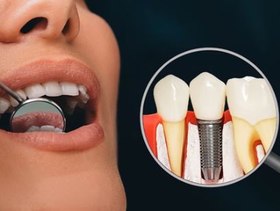 ایمپلنت دندان چیست و چه مراحلی دارد؟