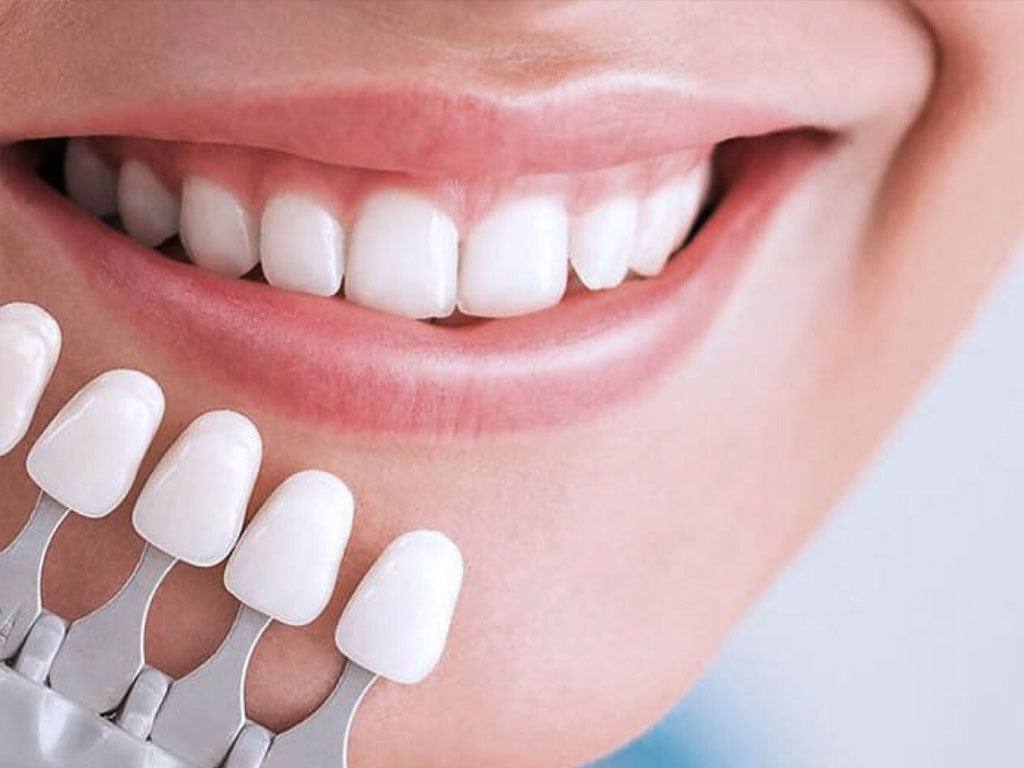 کامپوزیت دندان چیست؟ مزایا، معایب، مراحل انجام و مراقبت‌ها