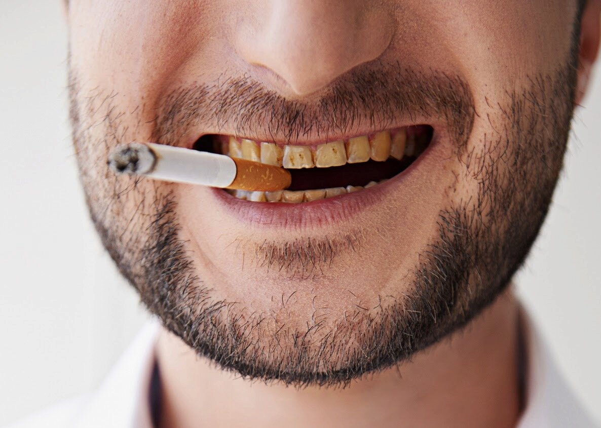  تاثیر سیگار بر دندان 