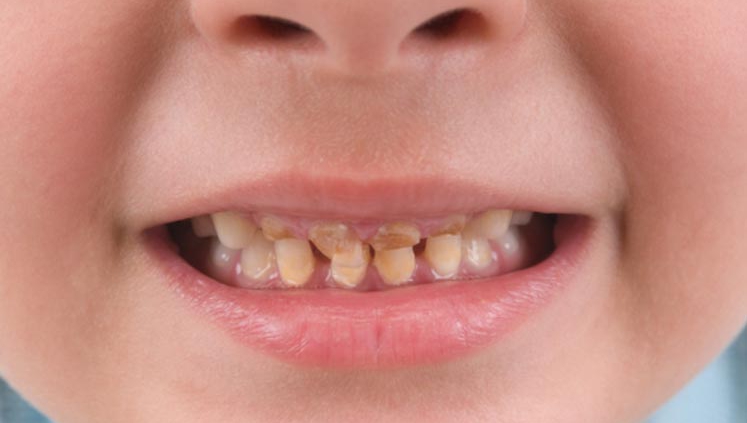 رفع پوسیدگی دندان در دندانپزشکی اطفال