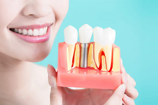 ایمپلنت دندان و مزایای استفاده از این روش درمانی