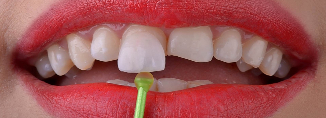 لمینت دندان با کیفیت چه ویژگی دارد؟