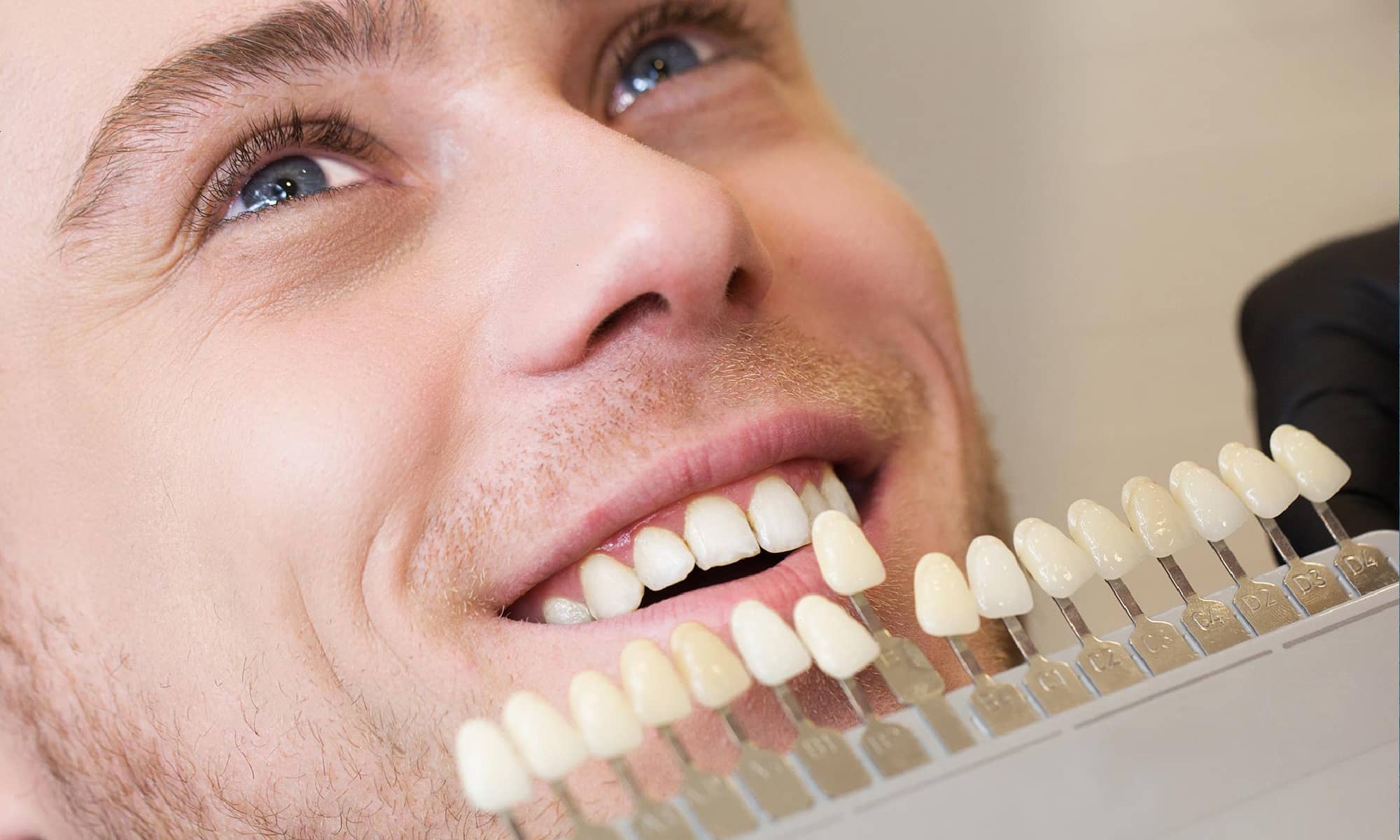 آیا لمینت دندان باعث خرابی دندان ها میشود؟