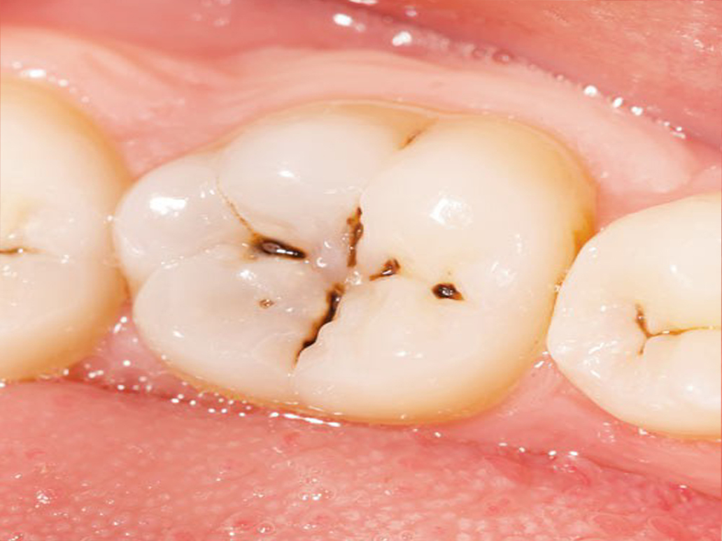 پوسیدگی های دندان