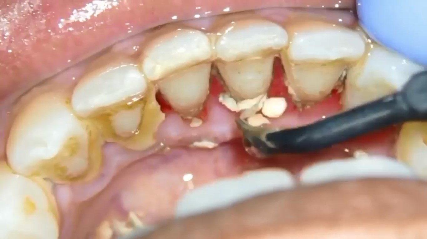 آیا من به جرم گیری دندان نیاز دارم؟