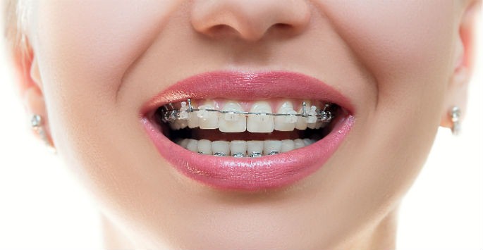 ارتودنسی دندان به چه کسانی توصیه میشود؟