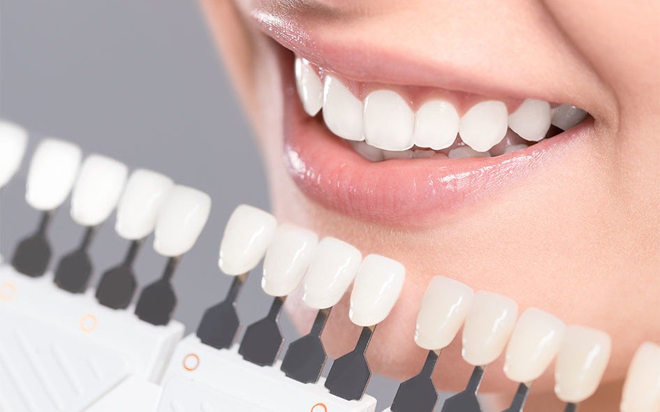 برای کامپوزیت دندان چه شرایطی لازم است؟