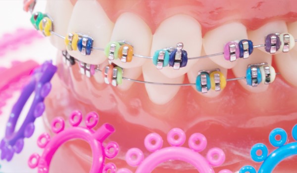 کش ارتودنسی  دندان