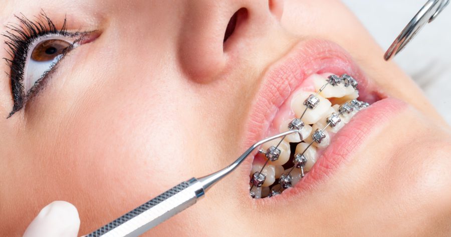 آیا ارتودنسی دندان معایبی دارد؟