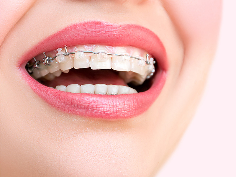 علل مختلف انجام ارتودنسی دندان