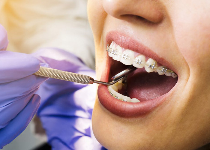 چرا در ارتودنسی دندان را میکشند؟