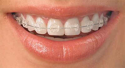 ارتودنسی-نامرئی-دندان