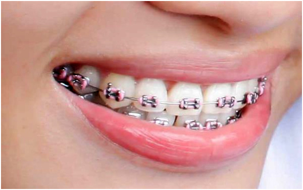 شرایط انجام ارتودنسی دندان