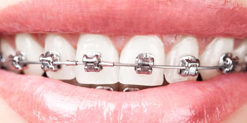 انجام ارتودنسی دندان
